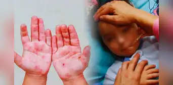Alerta en el norte del Perú por brote de virus Coxsackie: reportan más de 30 casos de la infección viral "mano, pie y boca"