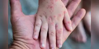 Casos de contagios por virus Coxsackie se duplicaron en colegios a nivel nacional, advierte el Minsa y Minedu Casos de contagios por virus Coxsackie se duplicaron en colegios a nivel nacional, advierte el Minsa y Minedu