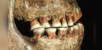 Un diente con un agujero revela que los neandertales practicaban la odontología con éxito usando ‘taladros’ de piedra Un diente con un agujero revela que los neandertales practicaban la odontología con éxito usando ‘taladros’ de piedra