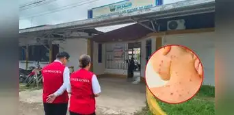 Sin fondos para emergencia por sarampión: pacientes en riesgo y posible aumento de contagios en Madre de Dios Sin fondos para emergencia por sarampión: pacientes en riesgo y posible aumento de contagios en Madre de Dios