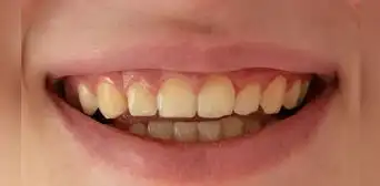 ¿Qué significa soñar que se te caen los dientes? Interpretaciones psicológicas y posibles explicaciones