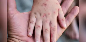 Amplían por 90 días emergencia sanitaria por brote de sarampión y riesgo de contagio en 11 regiones