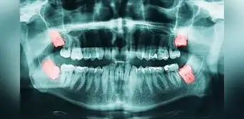 Científicos estudiaron dientes de ratón y descubrieron por qué las muelas del juicio causan tantos problemas en humanos