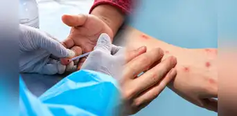 Casos de sífilis aumentan en Lima: varones de entre 20 y 34 años concentran más de la mitad de nuevos diagnósticos Casos de sífilis aumentan en Lima: varones de entre 20 y 34 años concentran más de la mitad de nuevos diagnósticos