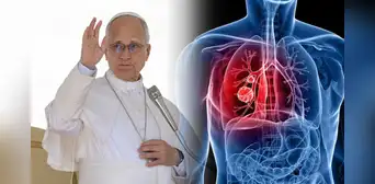 ¿El nódulo pulmonar del papa León XIV podría ser cáncer? Doctor Elmer Huerta  qué es y qué riesgo existe en operación