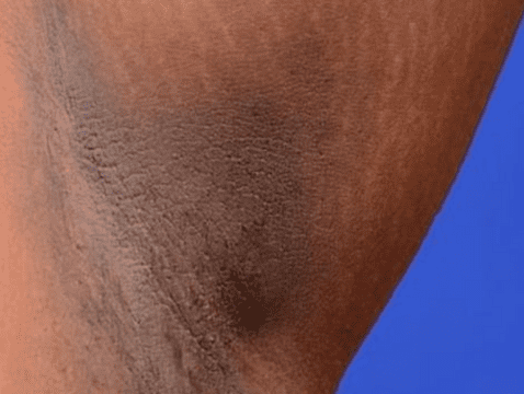 Dark spots in the armpits, neck or crotch can take months or years to disappear.  Photo: Your Doctor    