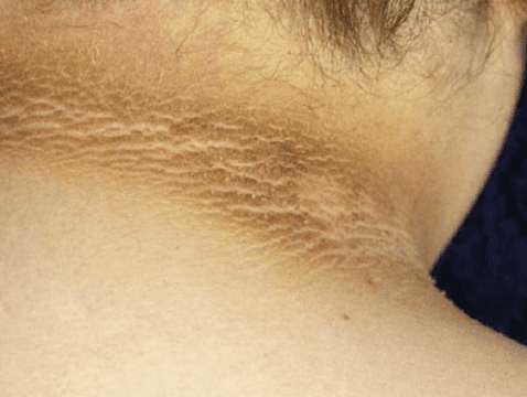 Acanthosis negricans is a sign that the person is at risk of diabetes.  Photo: NIH-GOV   