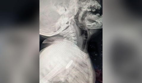  En la radiografía del niño demostró que una pila permanecía atascada en su esófago. Foto: Clarín    
