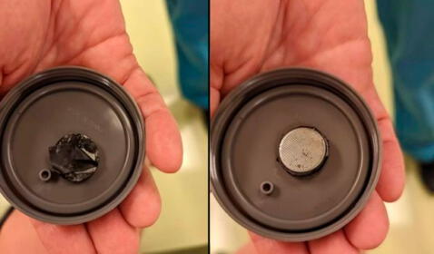  La pila tipo botón estaba envuelta en una cinta aislante. Los médicos creen que eso salvó la vida del menor porque evitó la corrosión. Foto: Clarín    