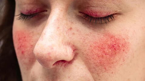 Rosacea mostly occurs in middle-aged women.  Photo: Medical News Today<br />   ” title=”Rosacea mostly occurs in middle-aged women.  Photo: Medical News Today<br />   ” height=”100%” width=”100%” loading=”lazy”/></p>
<!-- WP QUADS Content Ad Plugin v. 2.0.70.1 -->
<div class=