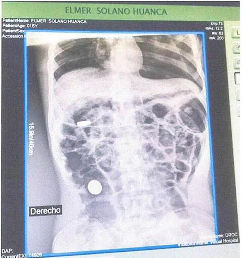Orificio de bala de calibre 7.65mm en el cuerpo de Elmer Solano Orificio de bala de calibre 7.65mm en el cuerpo de Elmer Solano