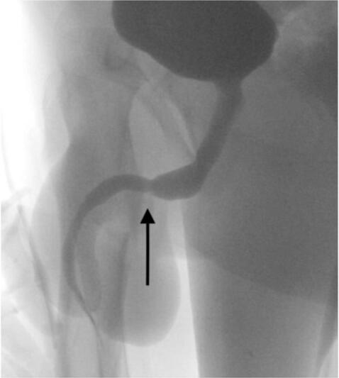 El cable lesionó la uretra. Foto: ScienceDirect.com   