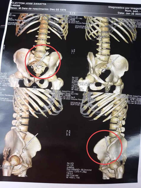 Hombre acude al hospital por dolor abdominal y encuentran tijeras quirúrgicas en su intestino 63e2bbe7a9715b42bd0f8cda