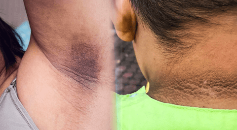 ¿Por qué me salen manchas oscuras en el cuello, axilas o entrepierna, y cómo eliminarlas?