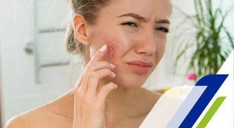 ¿Qué secuelas deja el acné tras el verano intenso?