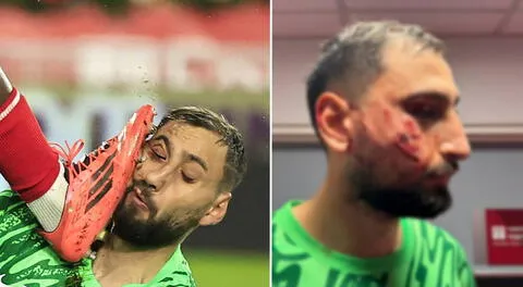 Donnarumma sufrió salvaje patada en el rostro y le pusieron 10 grapas: así quedó la cara del portero del PSG