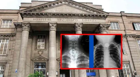 Anciana de 89 años se salva de morir tras tragar un anillo: médicos del Hospital Loayza lo extrajeron sin cirugía