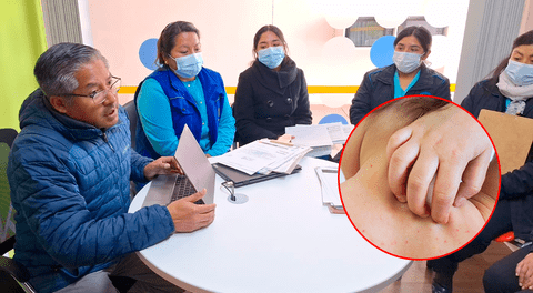 Alerta por varicela en Juliaca: 91 escolares contagiados y 7 instituciones intervenidas, incluida una universidad