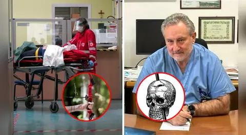 Adulto mayor sobrevivió dos días con una flecha clavada en la cabeza y llegó consciente al hospital en Italia