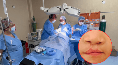 Arequipa: 40 niños serán operados gratis por labio fisurado y paladar hendido en campaña solidaria