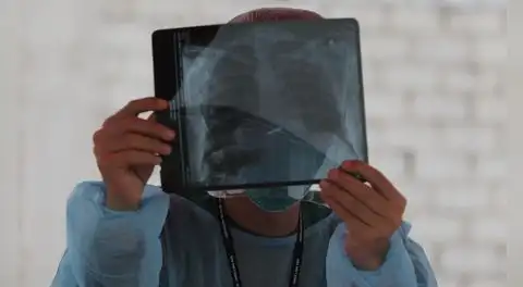 Perú es el país de América Latina con más casos de tuberculosis, según la OMS: Minsa reportó más de 33.000 pacientes en 2024