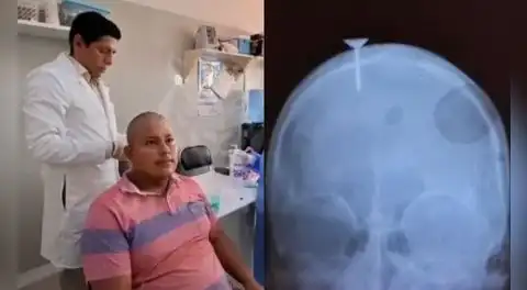 Obrero sobrevive a lesión en la cabeza ocasionada por clavo en Loreto: pistola neumática se activó por accidente
