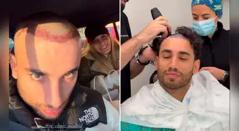 Said Palao impacta al mostrar su nueva imagen tras perder todo su cabello en tratamiento estético en España: “Esto recién empieza”