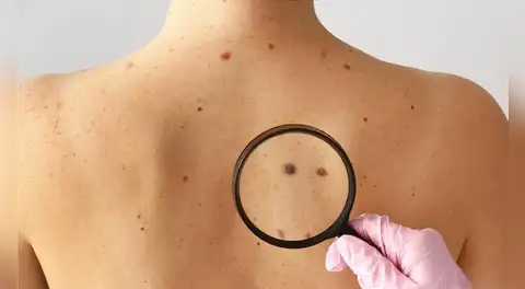 Las recomendaciones del Minsa para la detección temprana de lunares sospechosos y descartar cáncer de piel