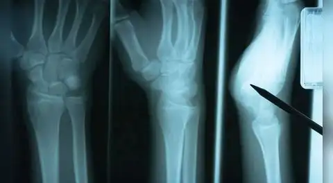 Estudio científico descubre proteína clave para la reparación de huesos después de sufrir una fractura