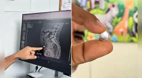 Niña de 6 años sobrevive a perforación intestinal tras ingerir pila de reloj: necesitó cirugía de más de tres horas