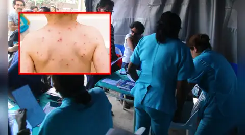 Alerta por sarampión en Perú: experto cuestiona preparación del sistema de salud ante riesgo de reintroducción