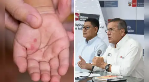 ¿Cerrarán colegios por virus Coxsackie? Esto dijo el Minedu ante el aumento de contagios en Lima y regiones