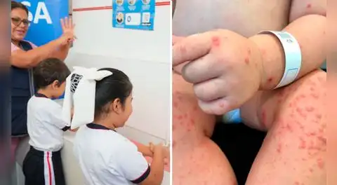 Aumenta a 1.658 los contagios por virus Coxsackie en el Perú, según Minsa: Lambayeque registra 300 casos en 50 colegios