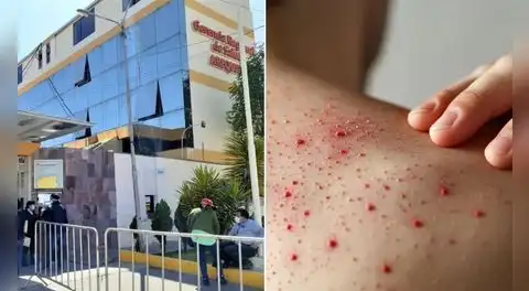 Sarampión se extiende en Perú: Arequipa confirma caso importado y refuerza prevención en colegios y terminales