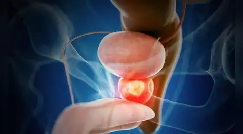 Ensayo clínico internacional demuestra eficacia de terapia combinada en cáncer de próstata agresivo: menos progresión y menor mortalidad