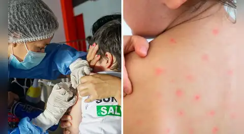 Confirman brote de sarampión en Loreto: Defensoría del Pueblo pide acciones urgentes para frenar transmisión