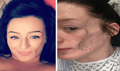 Rara enfermedad obligó a mujer a reconstruirse el rostro con grasa de su estómago Rara enfermedad obligó a mujer a reconstruirse el rostro con grasa de su estómago