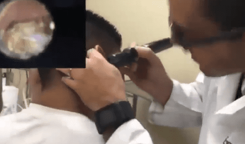 Facebook viral: nunca imaginarás la aterradora criatura que encontró este joven dentro de su oído [VIDEO] 
