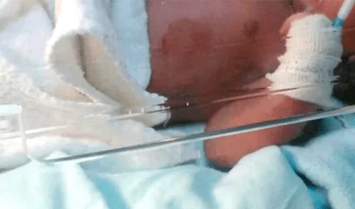 Bebé de 8 meses víctima de maltrato infantil termina con el brazo fracturado Bebé de 8 meses víctima de maltrato infantil termina con el brazo fracturado