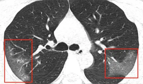 Las manchas blancas se extienden hasta los bordes de los pulmones de la paciente infectada por el coronavirus 2019-nCoV. Crédito: First Hospital of Lanzhou University.