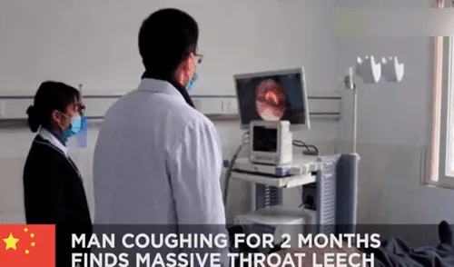 Fue al hospital para tratarse una tos y descubren dos parásitos alojados en su garganta Fue al hospital para tratarse una tos y descubren dos parásitos alojados en su garganta