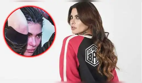 Angie Jibaja aparece con moretón en el brazo y niega que haya recaído en las drogas [VIDEO]