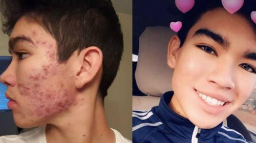 YouTube: el extraño tratamiento que uso adolescente para vencer acné severo  [VIDEO]