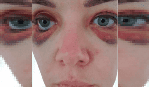 Mujer terminó con los párpados destrozados tras hacerse delineado permanente
