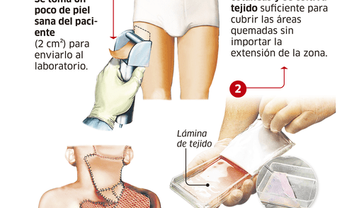 Nueva piel a partir de células cutáneas