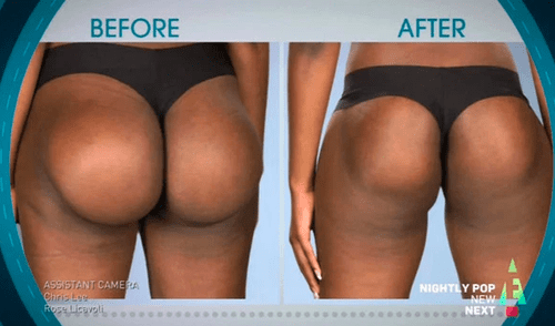 Mujer gastó 4 mil dólares por implantes de glúteos, pero el resultado fue desastroso [FOTOS]