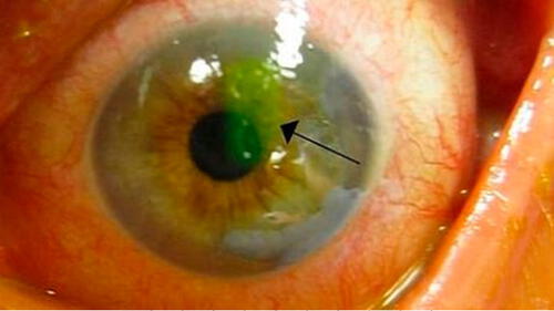Médicos encuentran cuatro abejas vivas dentro del ojo de una mujer [FOTOS]