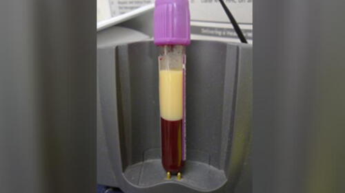 Médicos alemanes extraen ‘sangre blanca’ a paciente por el exceso de grasa que tenía