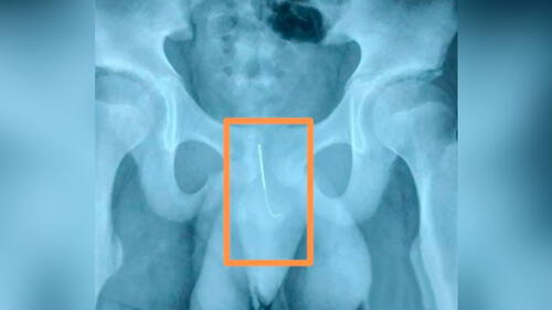 La aguja de 10 cm podía dañar su vejiga o destruir arterias. Foto: AsiaWire.