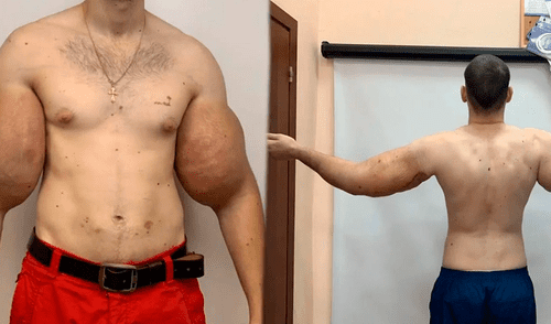 ‘Popeye ruso’ se somete a cirugía y médicos le sustraen el doloroso líquido de sus bíceps ‘Popeye ruso’ se somete a cirugía y médicos le sustraen el doloroso líquido de sus bíceps